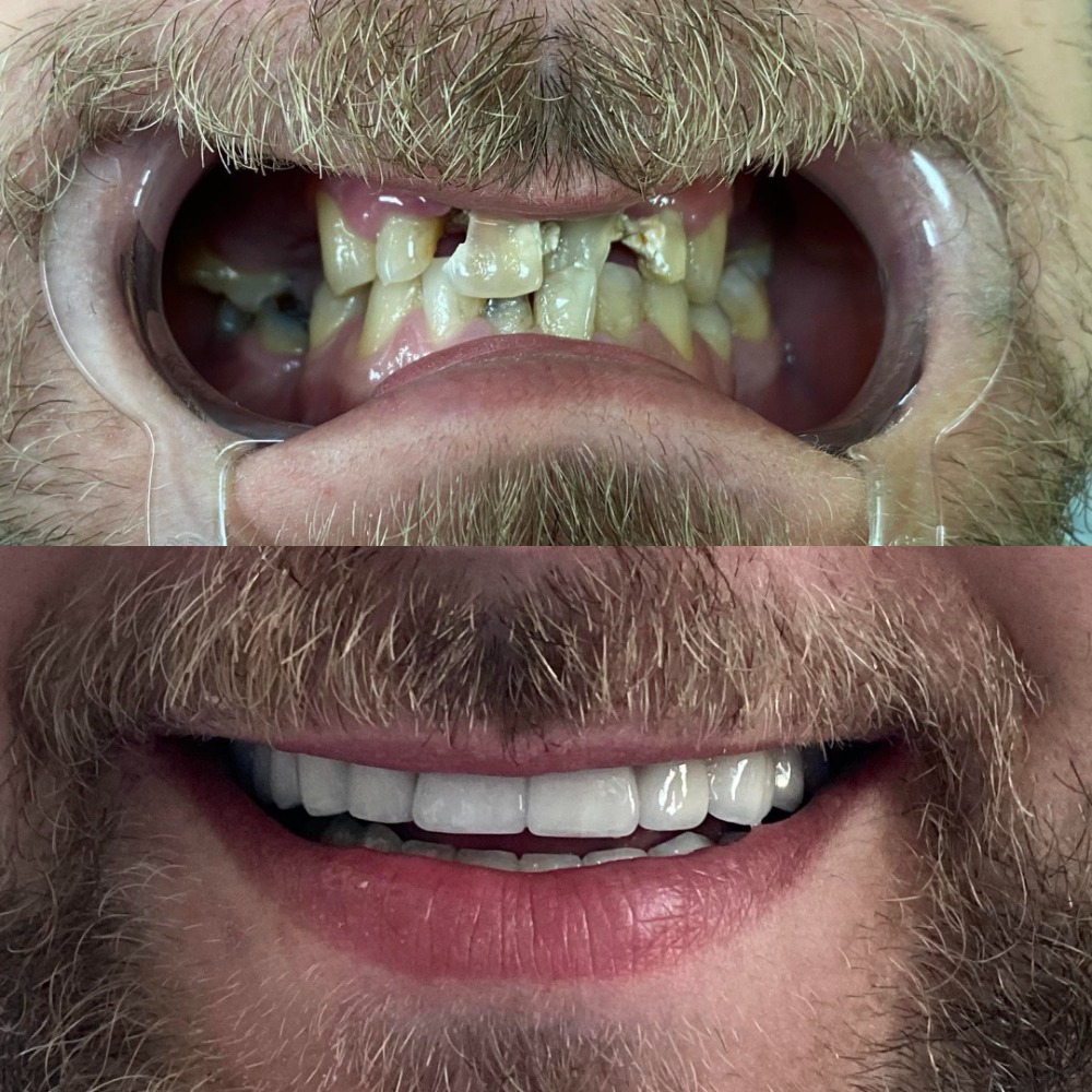Smile transformation