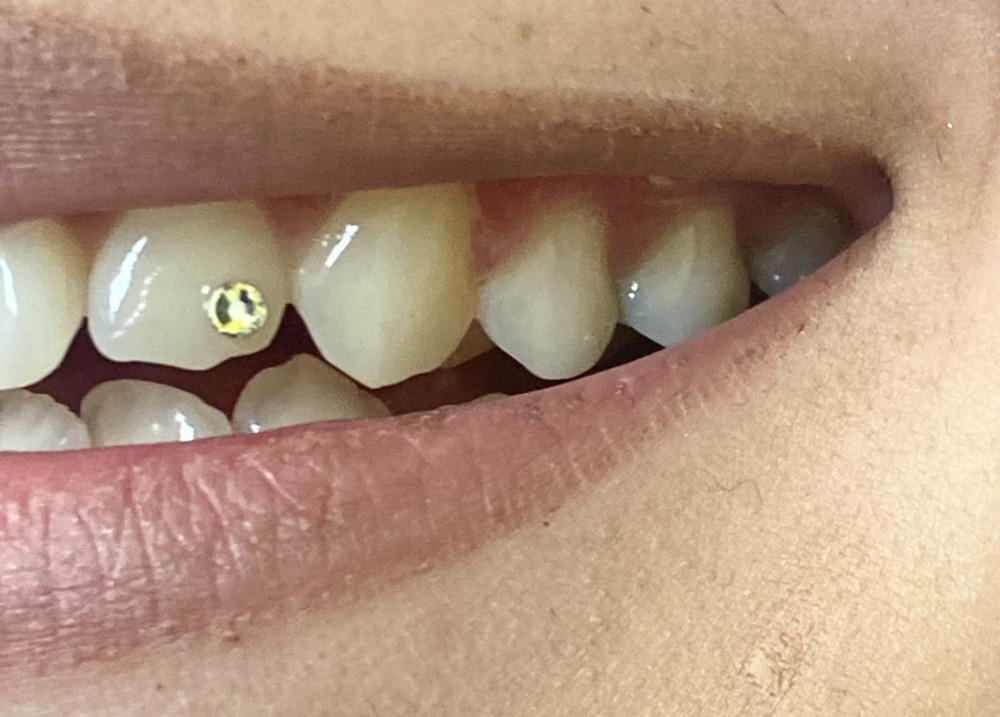 Tooth gem