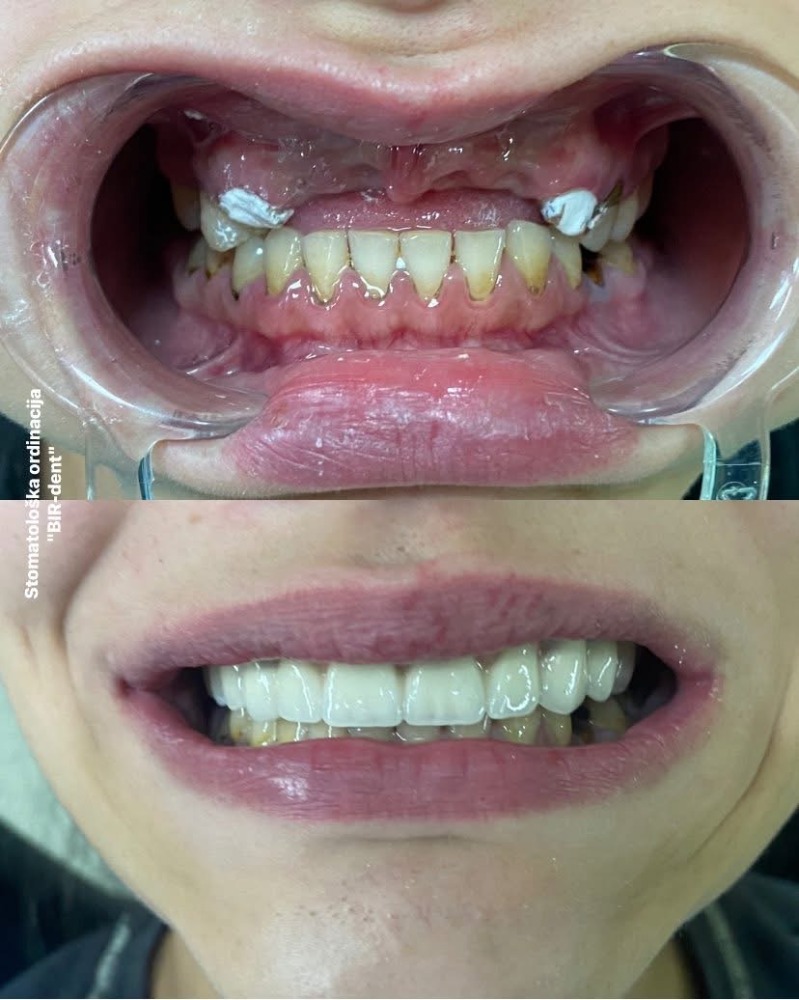 Before and after