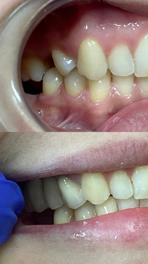 Fixed prosthetic restoration