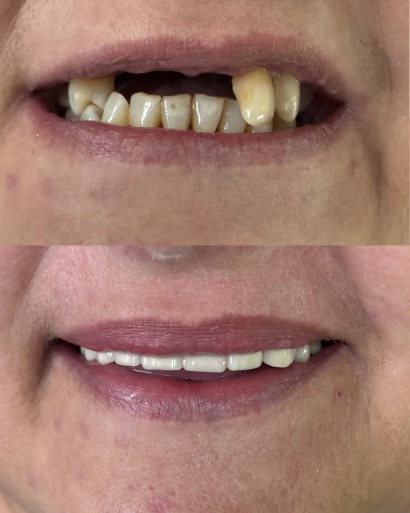 Upper arch rehabilitation