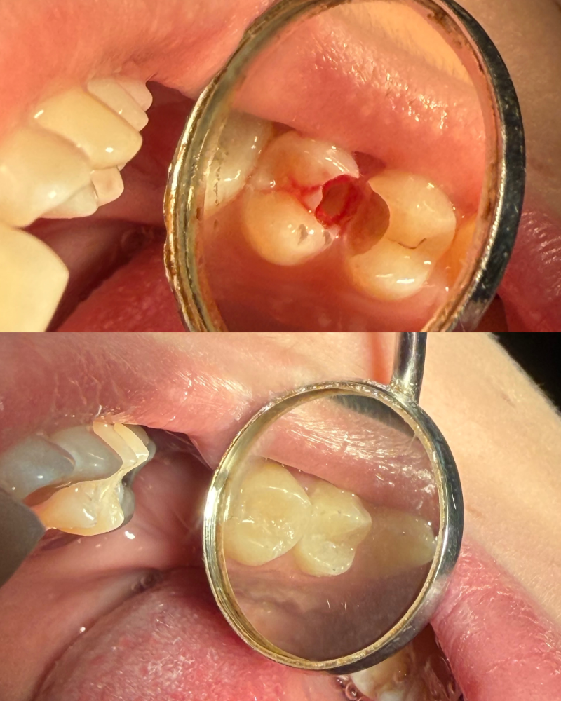 Composite fillings