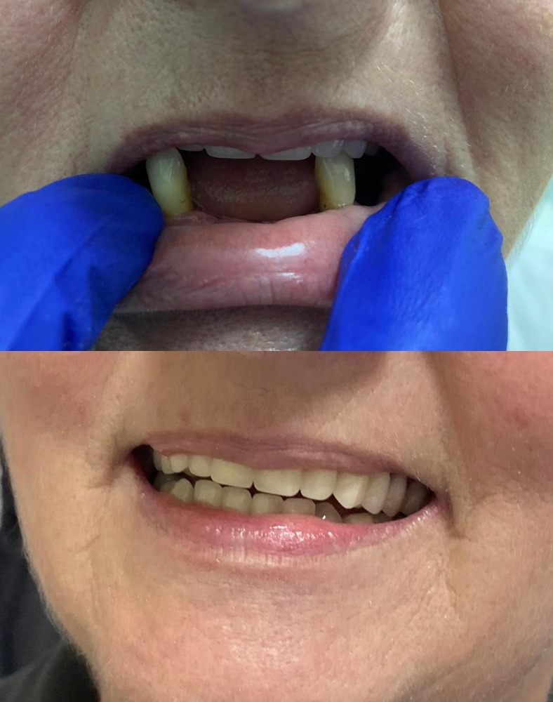 Partial denture