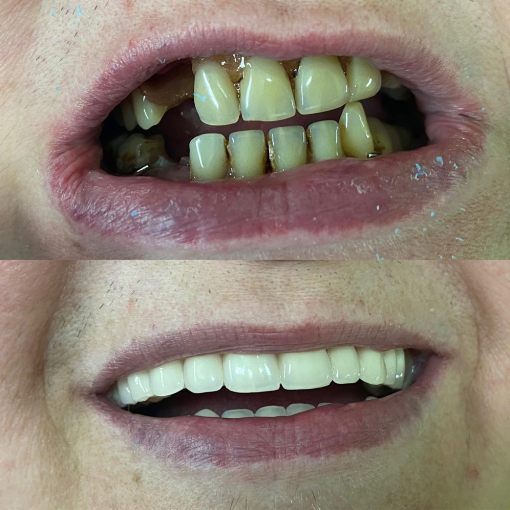 Complete dentures