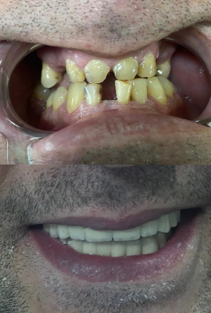 Smile reconstruction